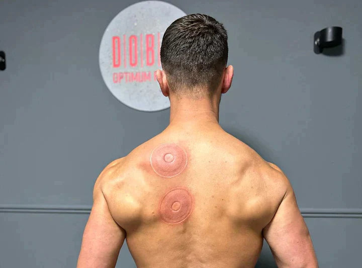 SmartCup — Cupping Therapy Device
