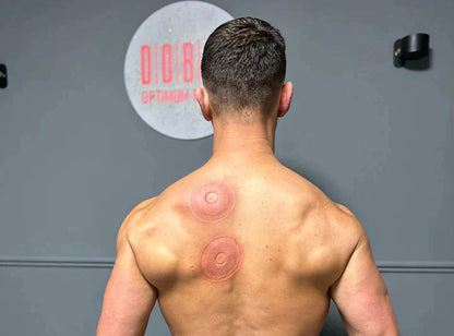 SmartCup — Cupping Therapy Device